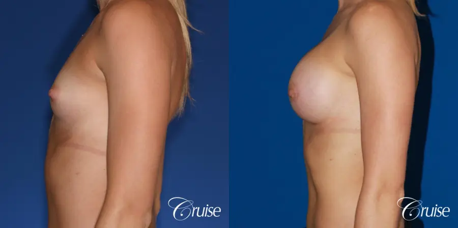 Breast Augmentation - Before and After 2