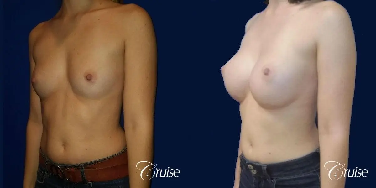 Breast Augmentation - Before and After 2