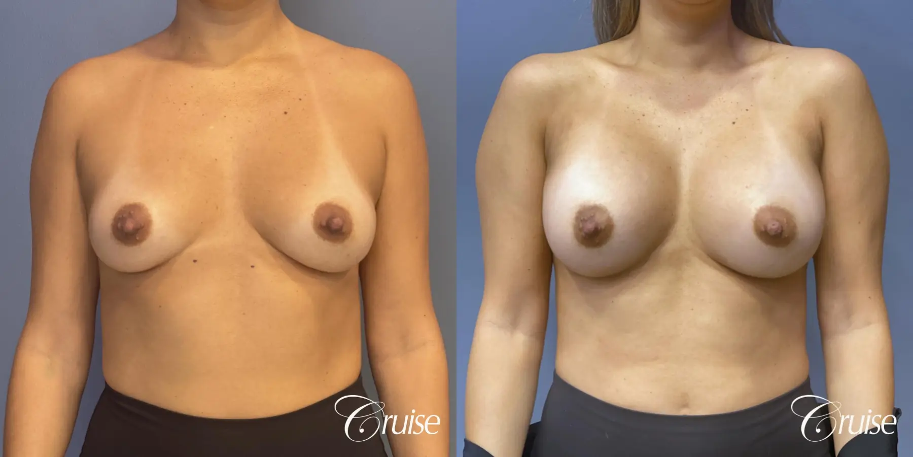 Breast Augmentation: Patient 70 - Before and After 1