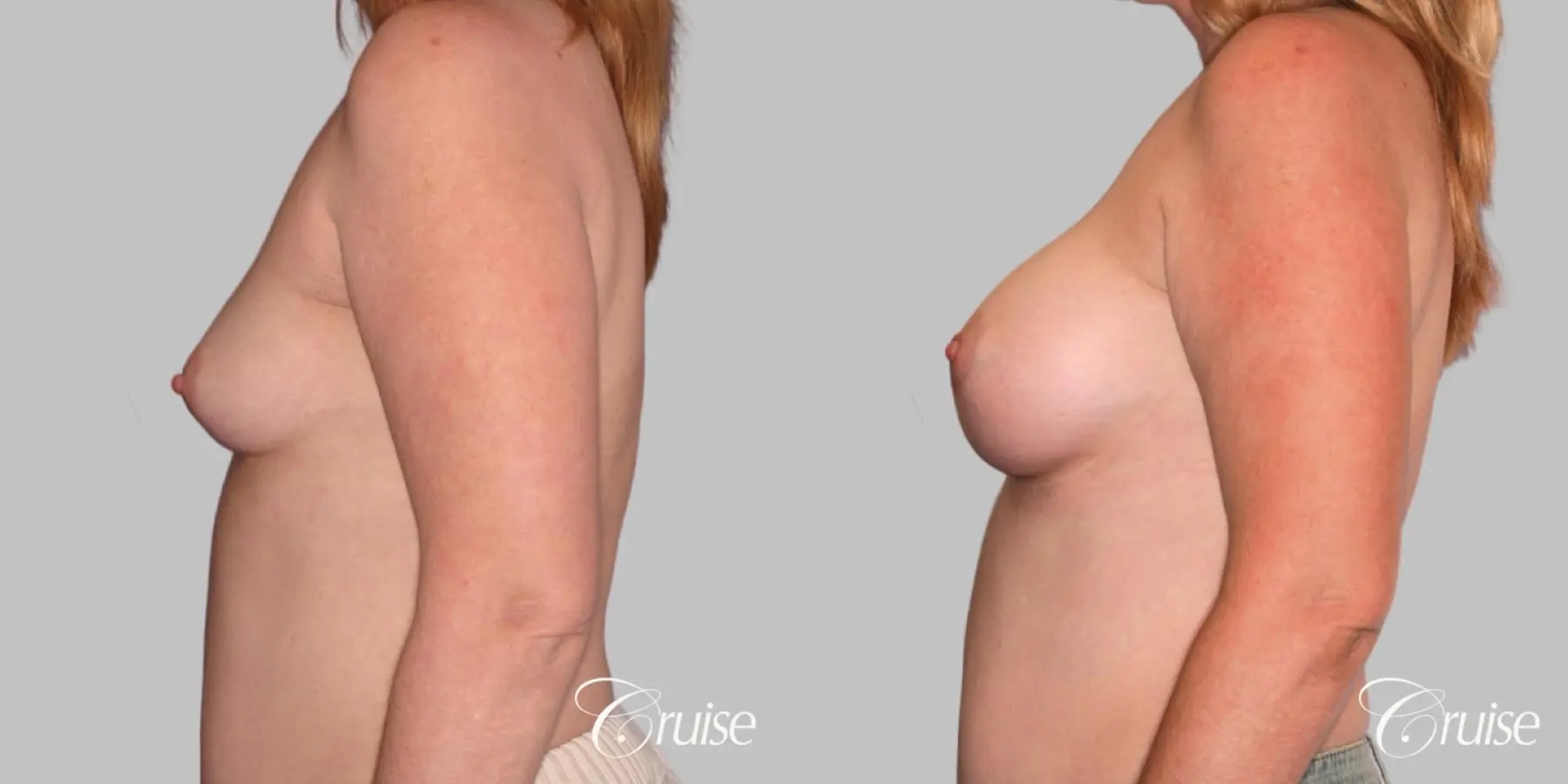 Breast Augmentation - Silicone HP 475cc - Before and After 2