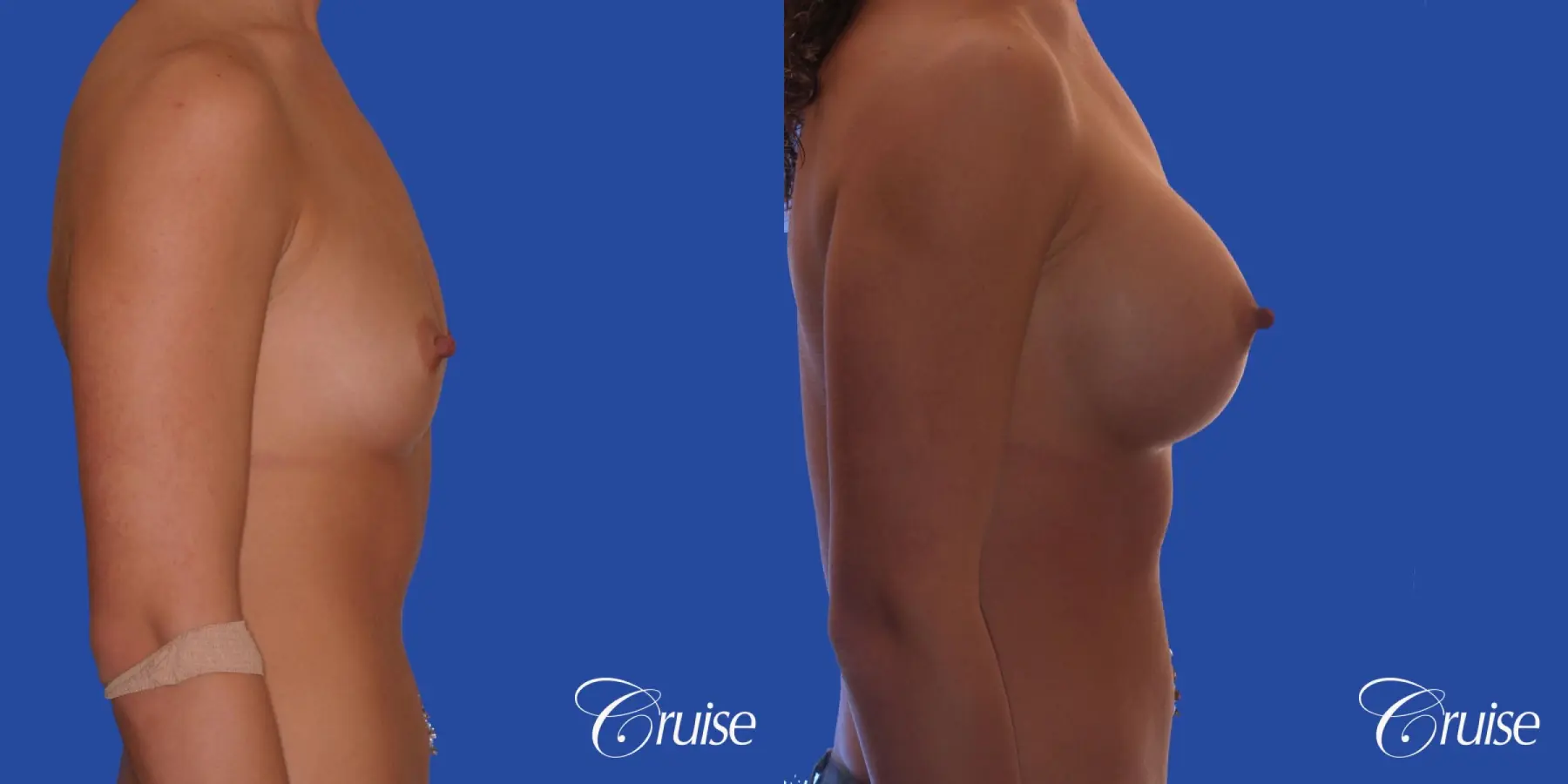 Breast Augmentation - Before and After 3