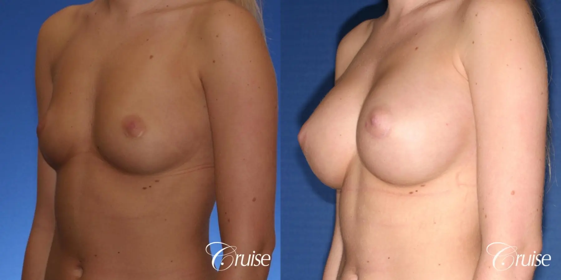 Breast Augmentation - Before and After 3