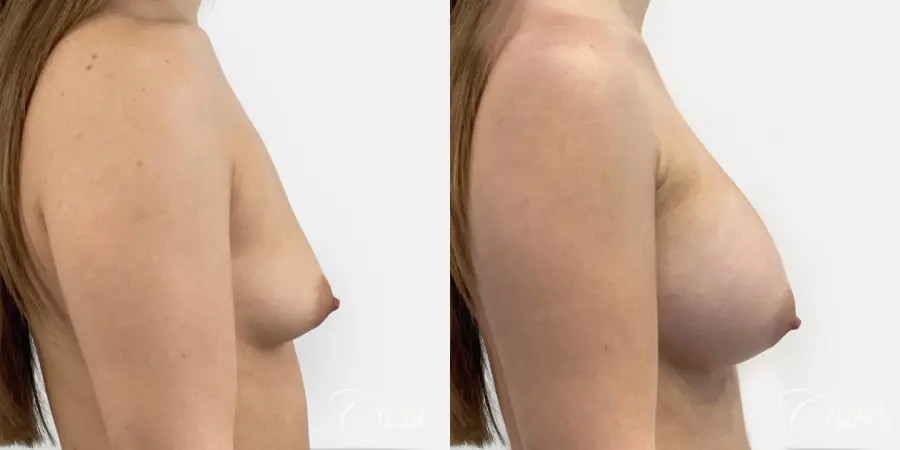 Silicone Gel Breast Implants - Before and After 3