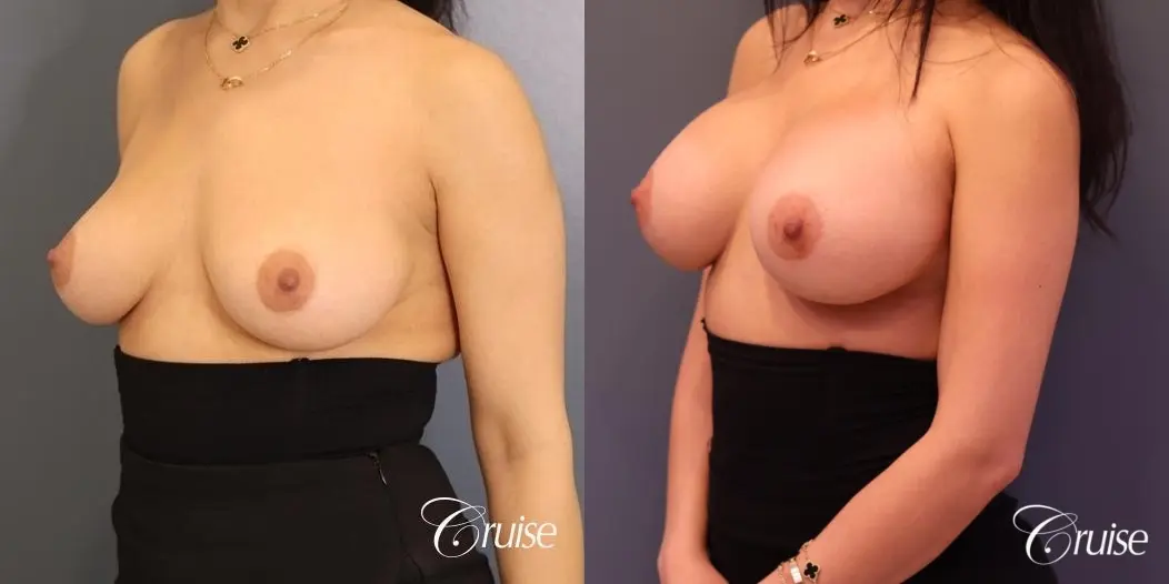 Breast Augmentation: Patient 71 - Before and After 2