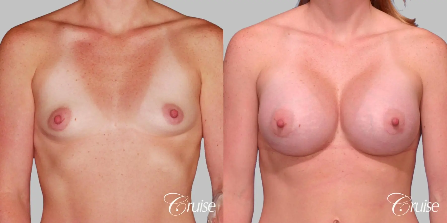 Breast Augmentation - Saline HP 450cc - Before and After 1