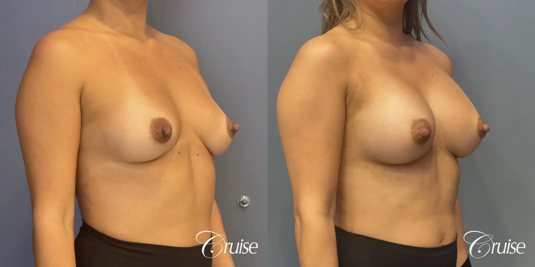 Breast Augmentation: Patient 70 - Before and After 5