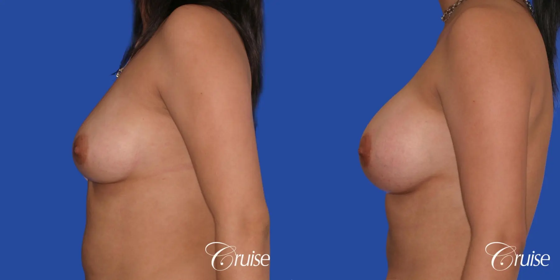 Breast Augmentation - Before and After 2