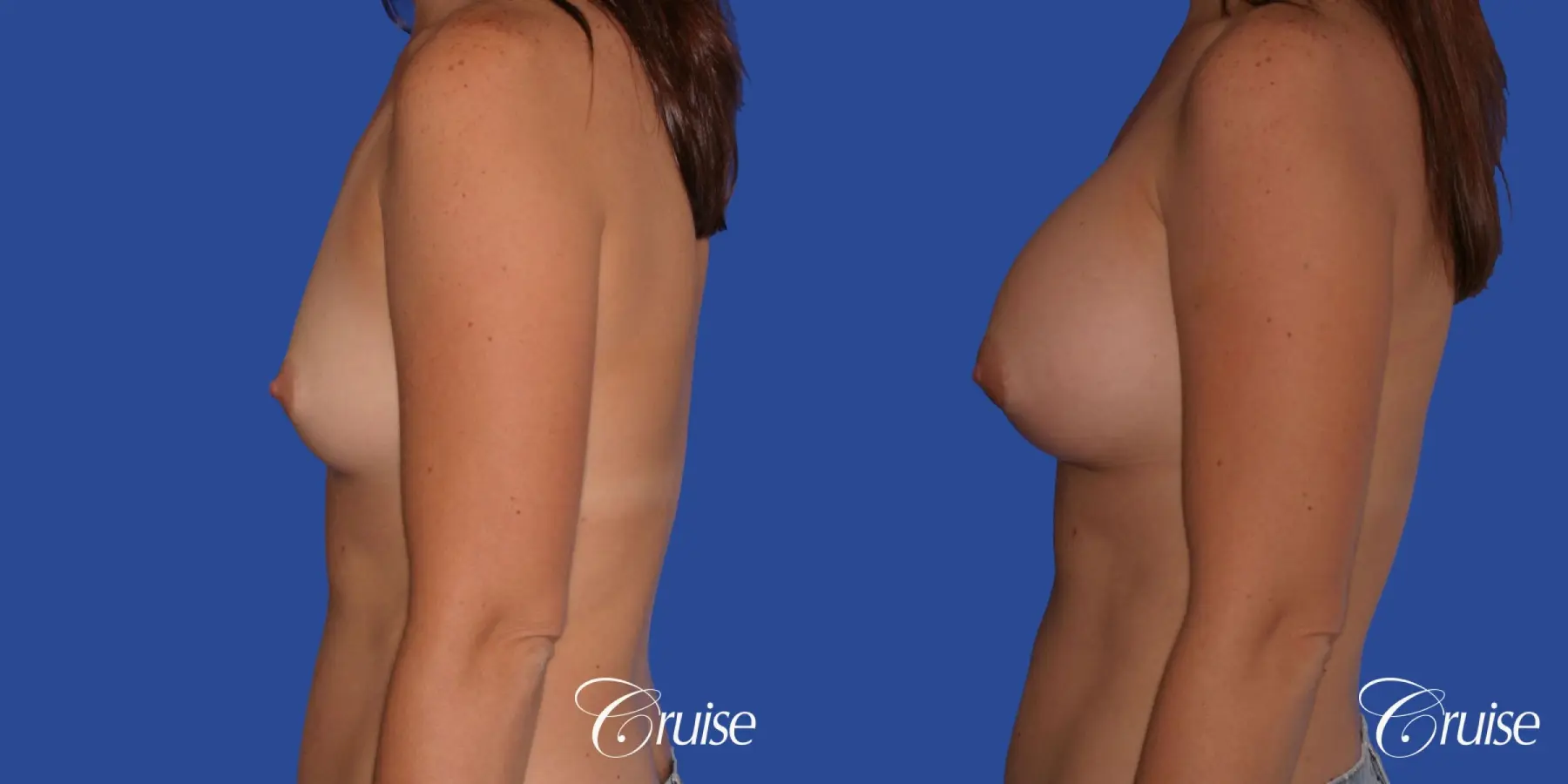 Breast Augmentation - Before and After 2