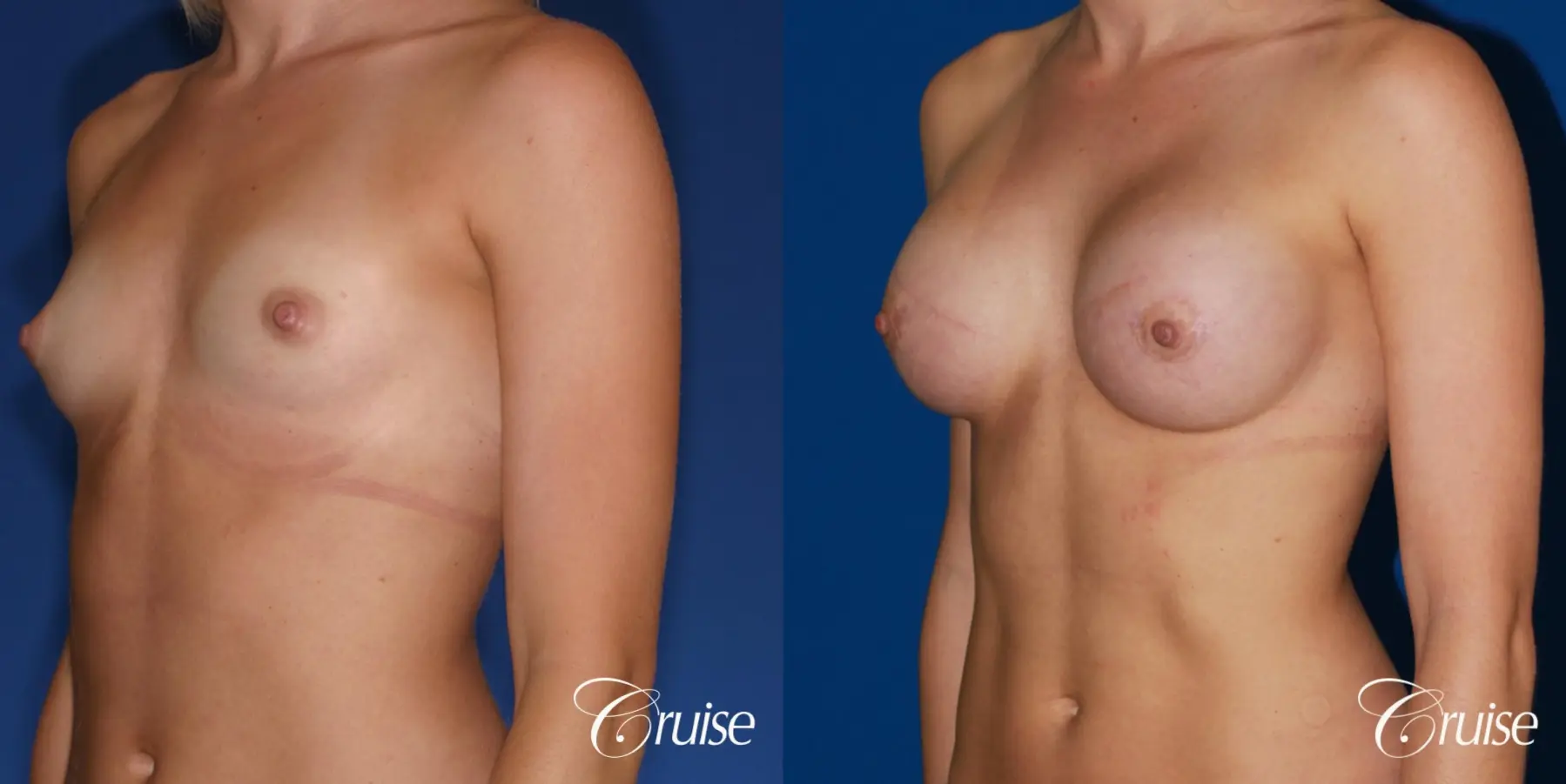 Breast Augmentation - Before and After 3