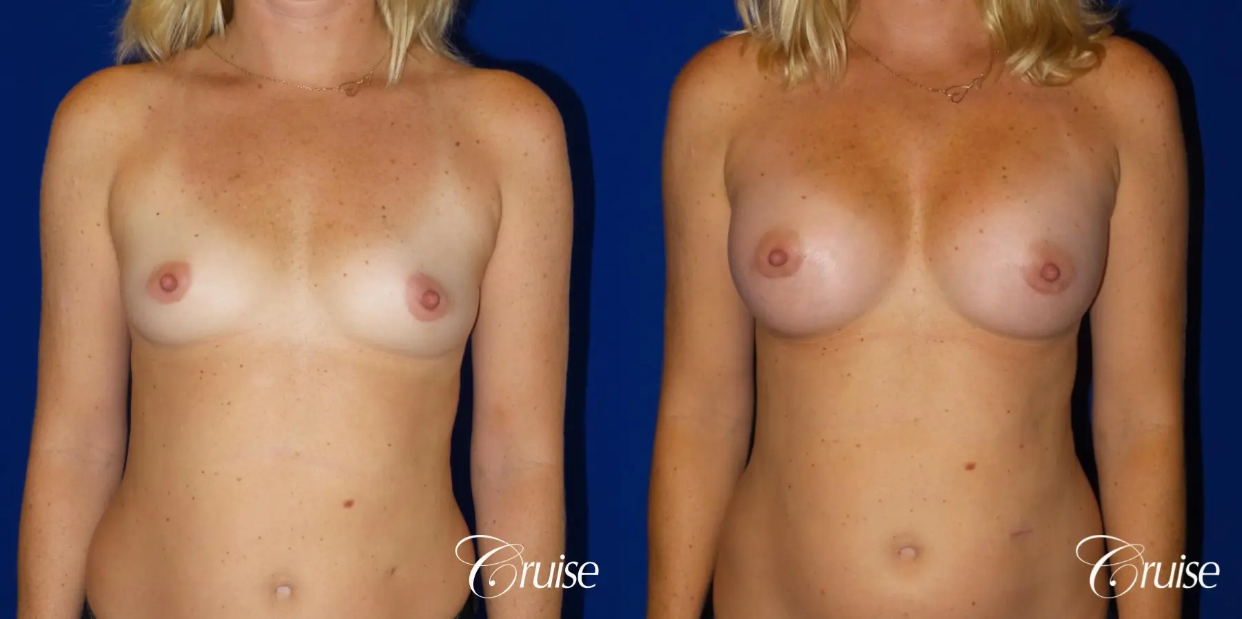 Breast Augmentation - Before and After  