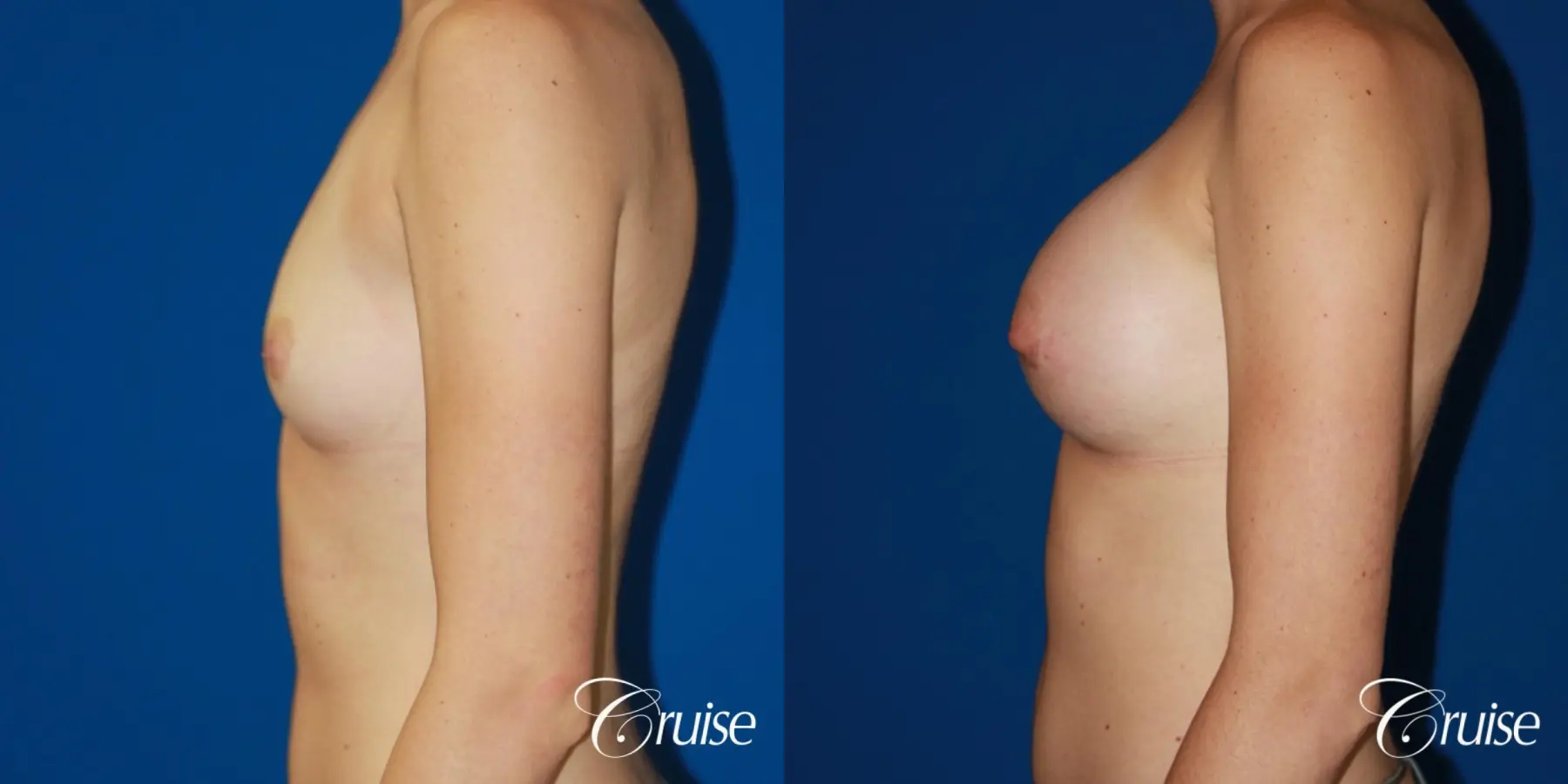 Breast Augmentation - Before and After 2