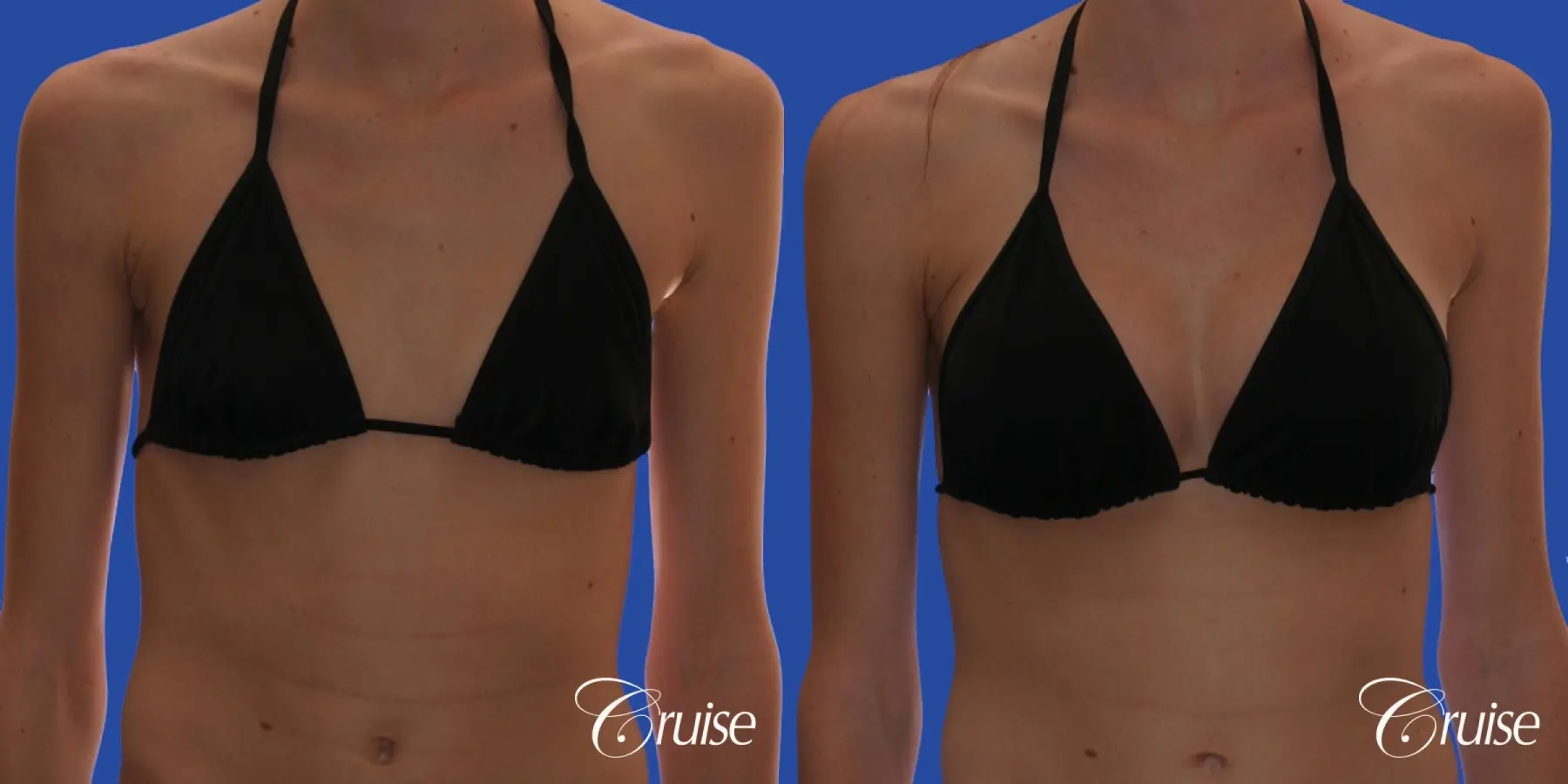 Breast Augmentation - Before and After 4