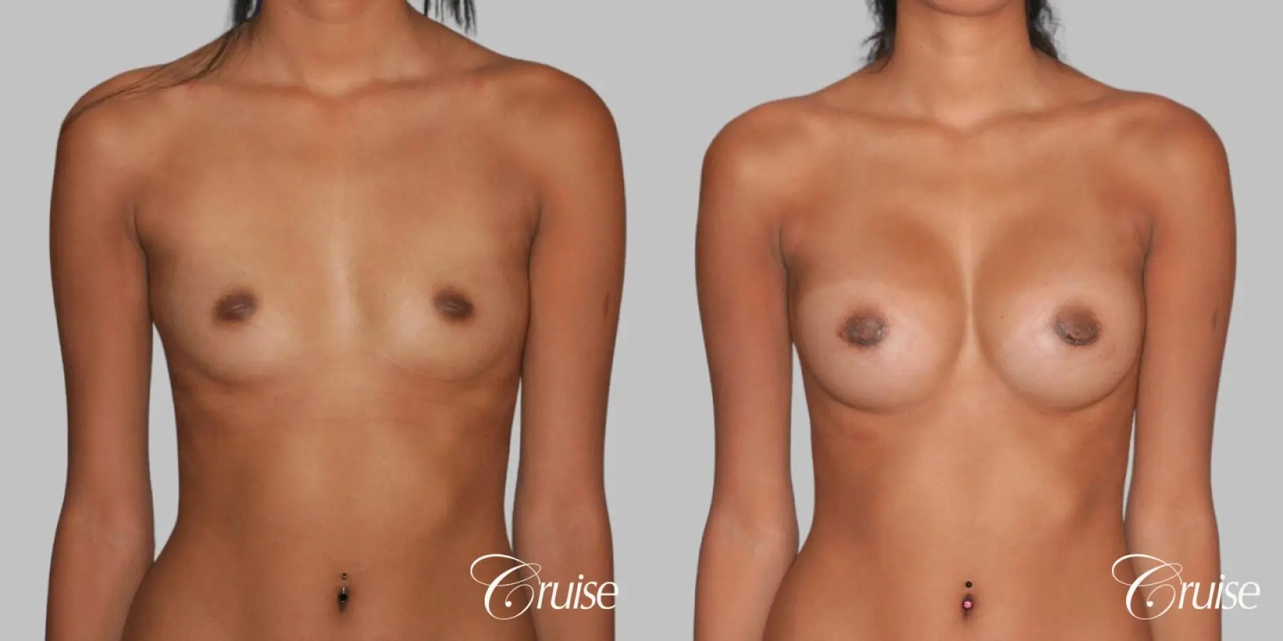 Breast Augmentation - Silicone MP 371cc - Before and After 1