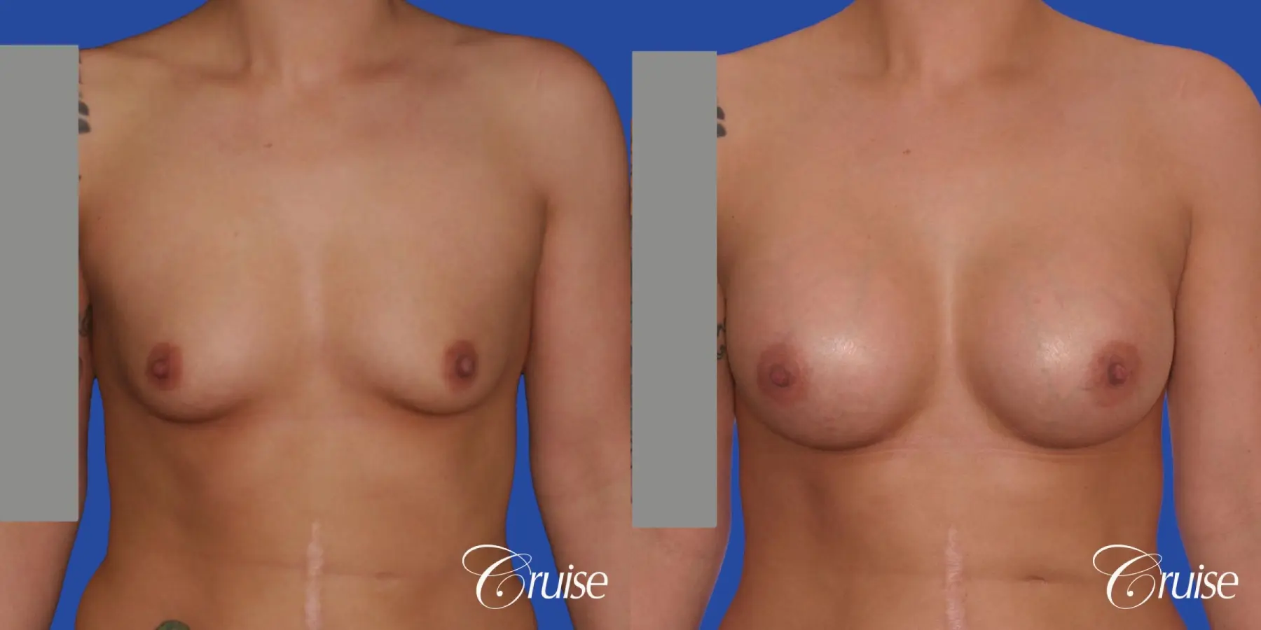 Breast Augmentation - Before and After 1