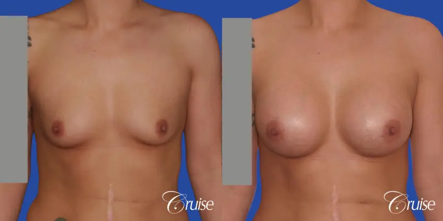 Breast Augmentation - Before and After 1