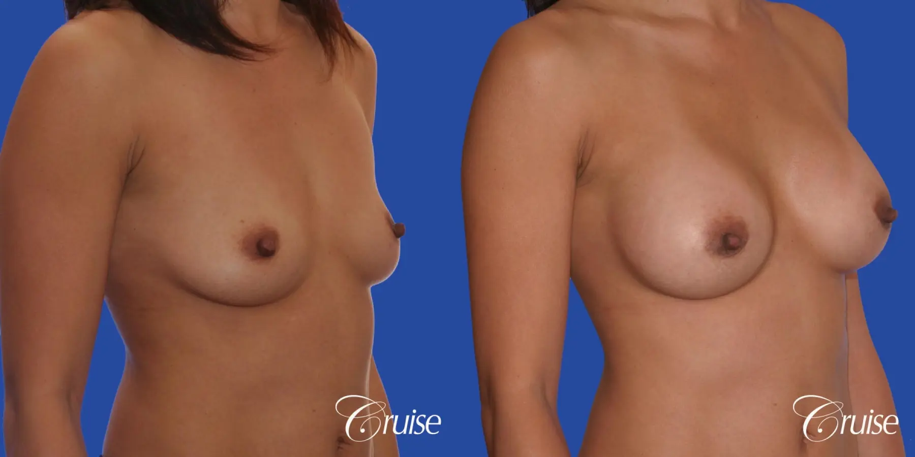 Breast Augmentation - Before and After 4