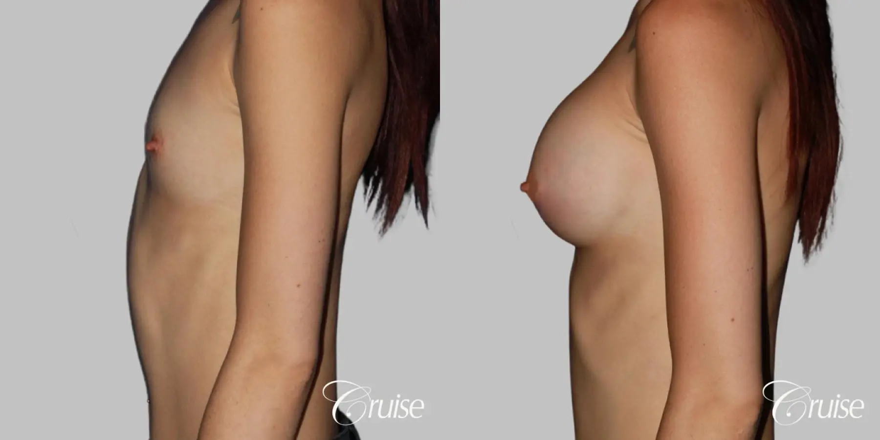 Breast Augmentation on Petite Patient - HP 375cc (silicone) - Before and After 3