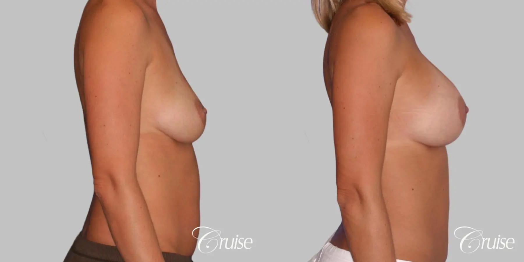 Breast Augmentation - Silicone MP 339cc - Before and After 3