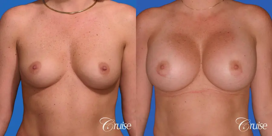 Breast Augmentation - Before and After  