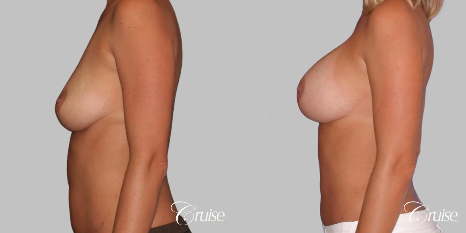 Breast Augmentation - Silicone MP 339cc - Before and After 2