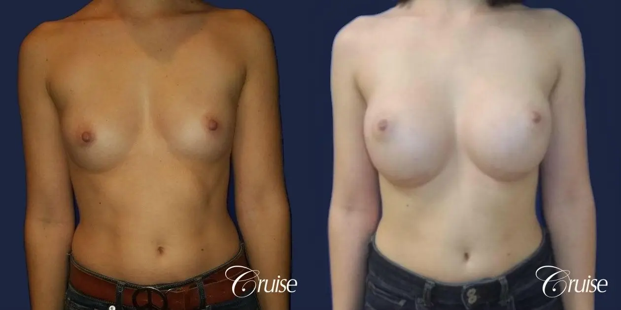 Breast Augmentation - Before and After 1