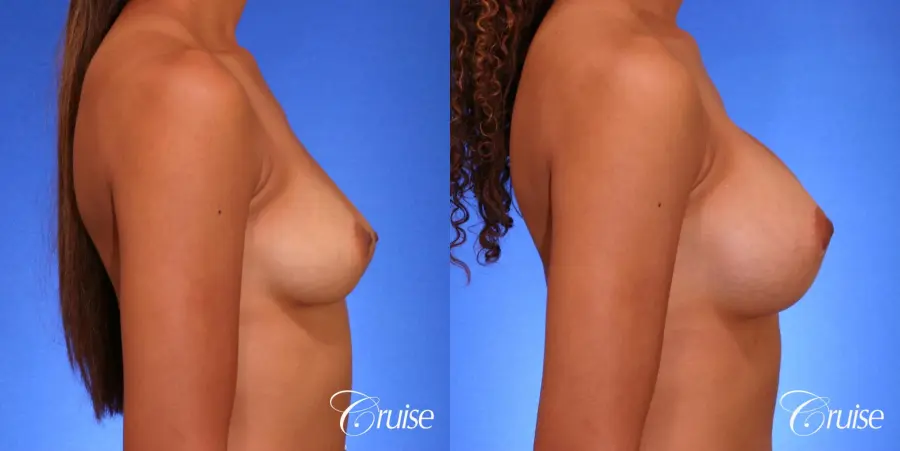Breast Augmentation - Before and After 3