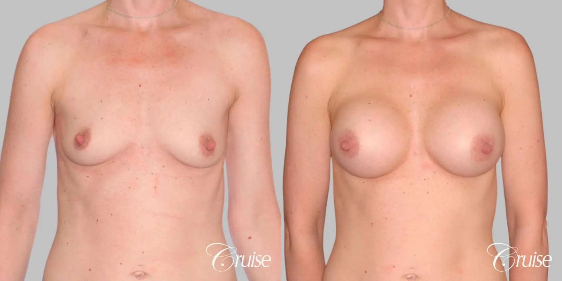Breast Augmentation - Silicone HP 375cc - Before and After 1