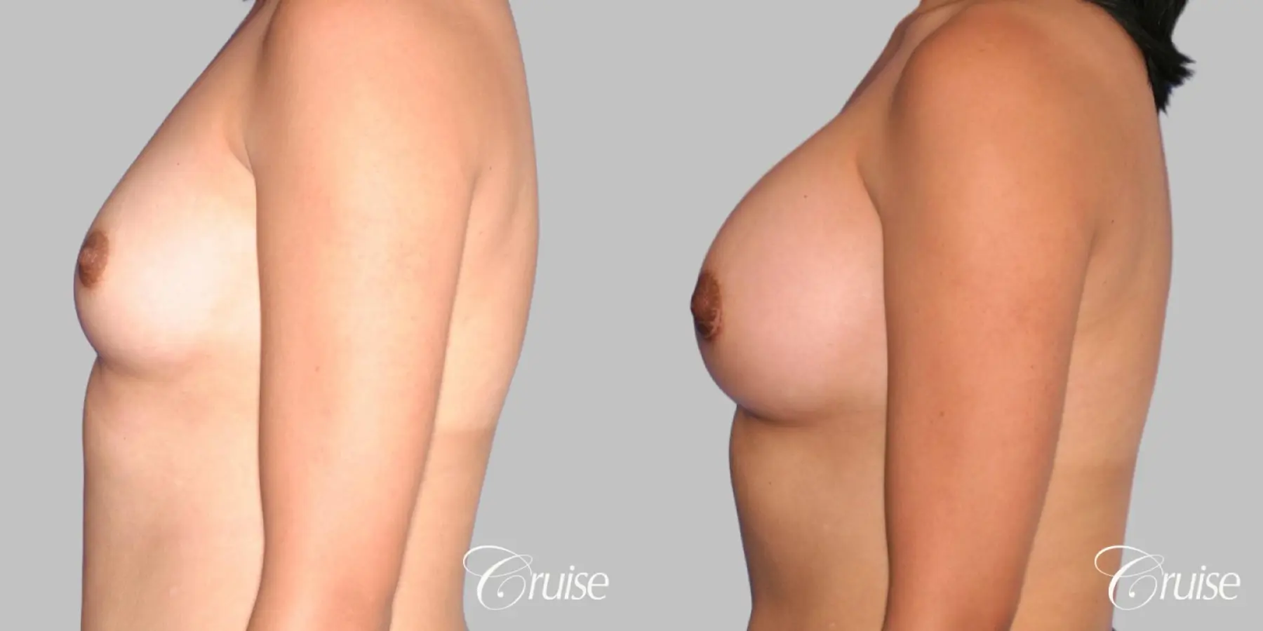Breast Augmentation - Saline MP 285cc - Before and After 2