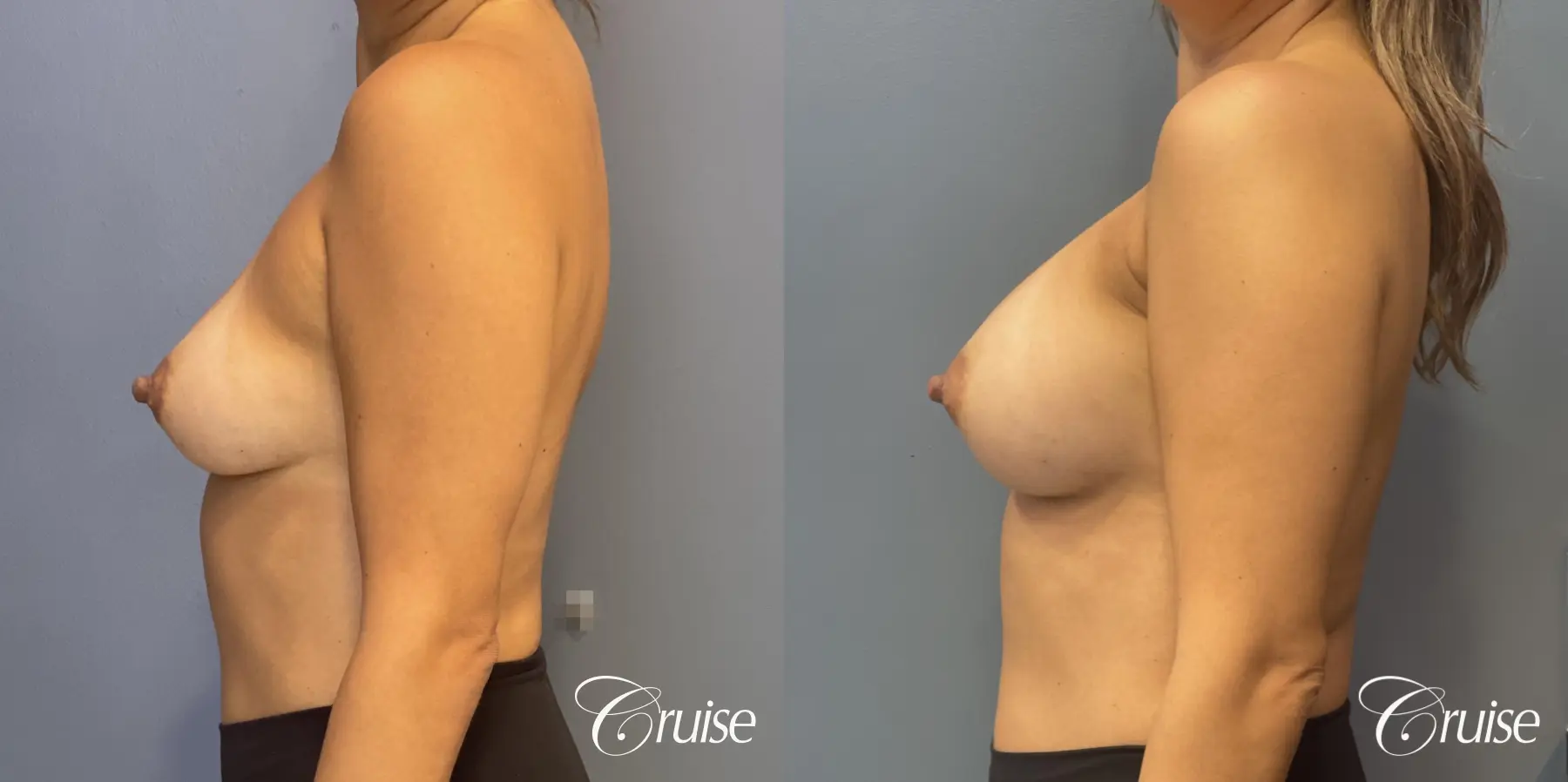 Breast Augmentation: Patient 70 - Before and After 2