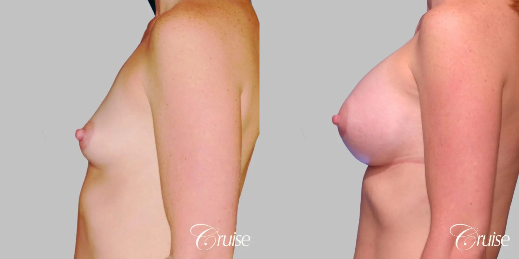 Breast Augmentation - Saline HP 450cc - Before and After 2
