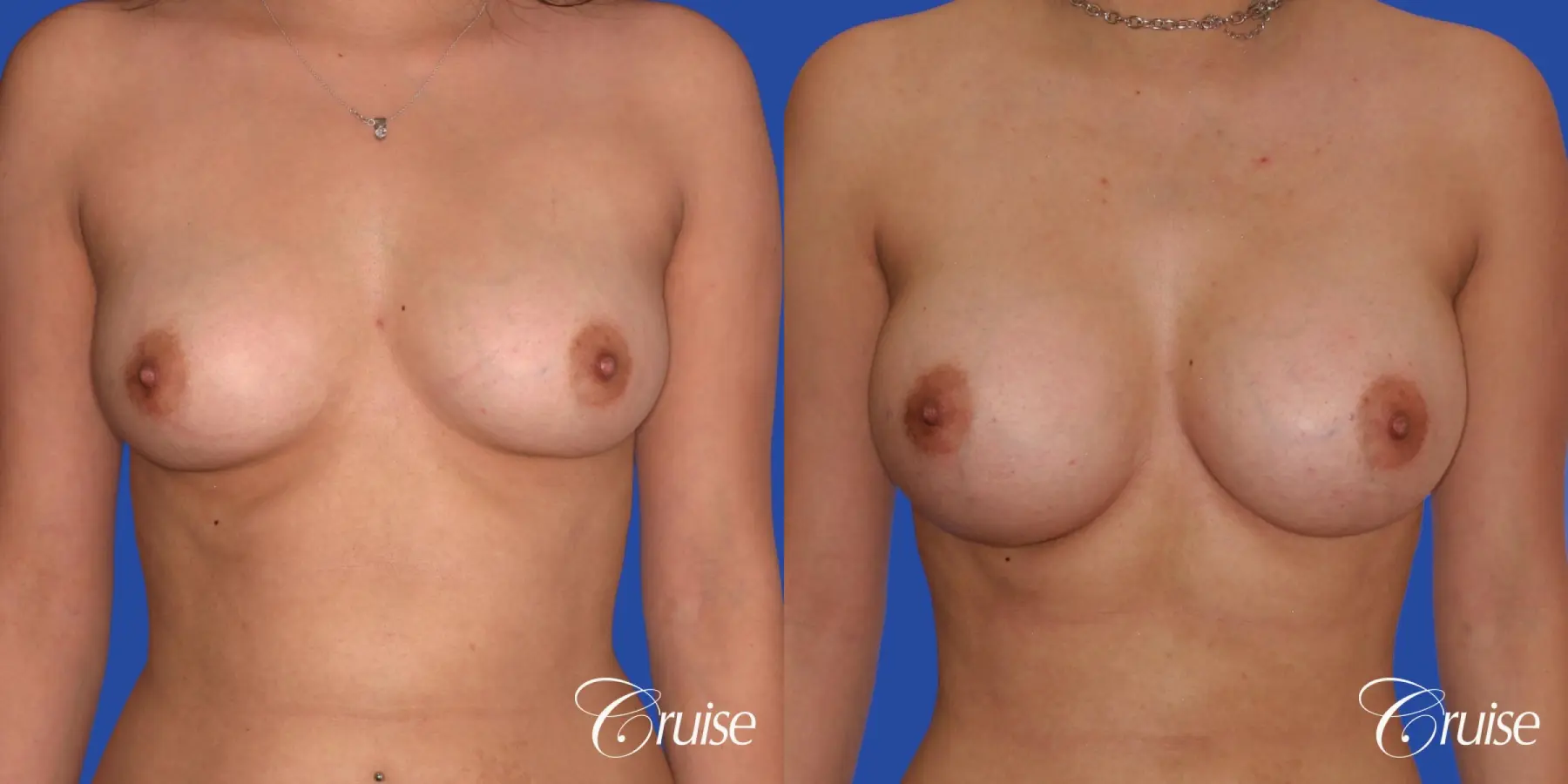 Breast Augmentation - Before and After 1