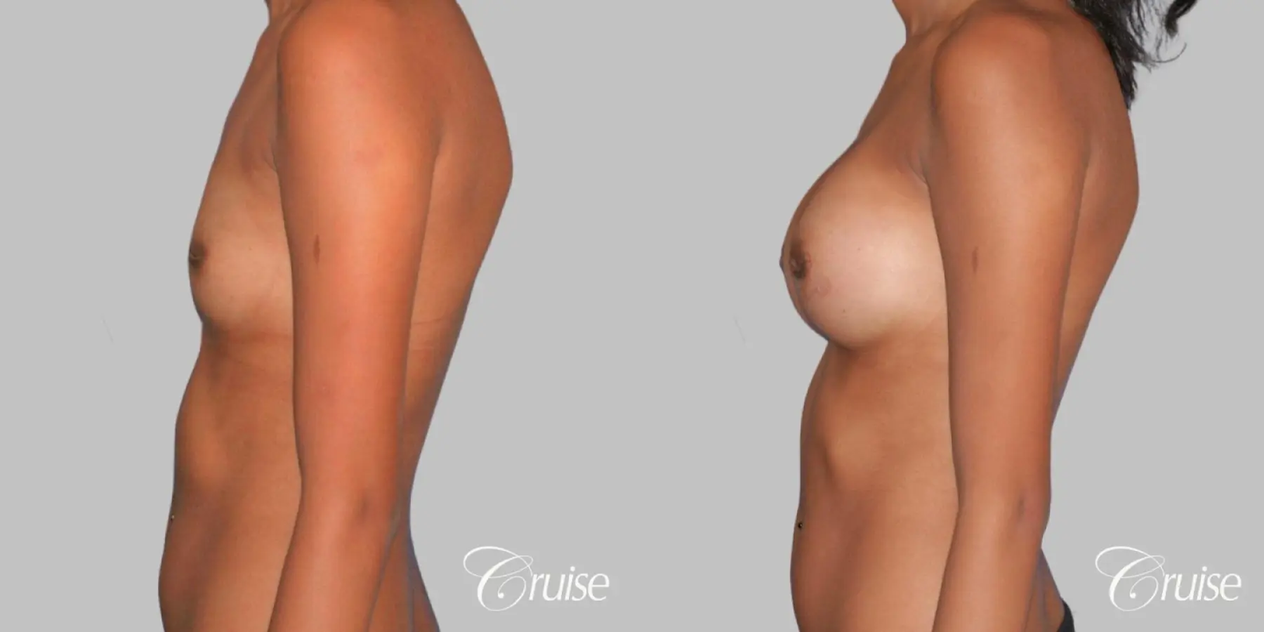 Breast Augmentation - Silicone MP 371cc - Before and After 3