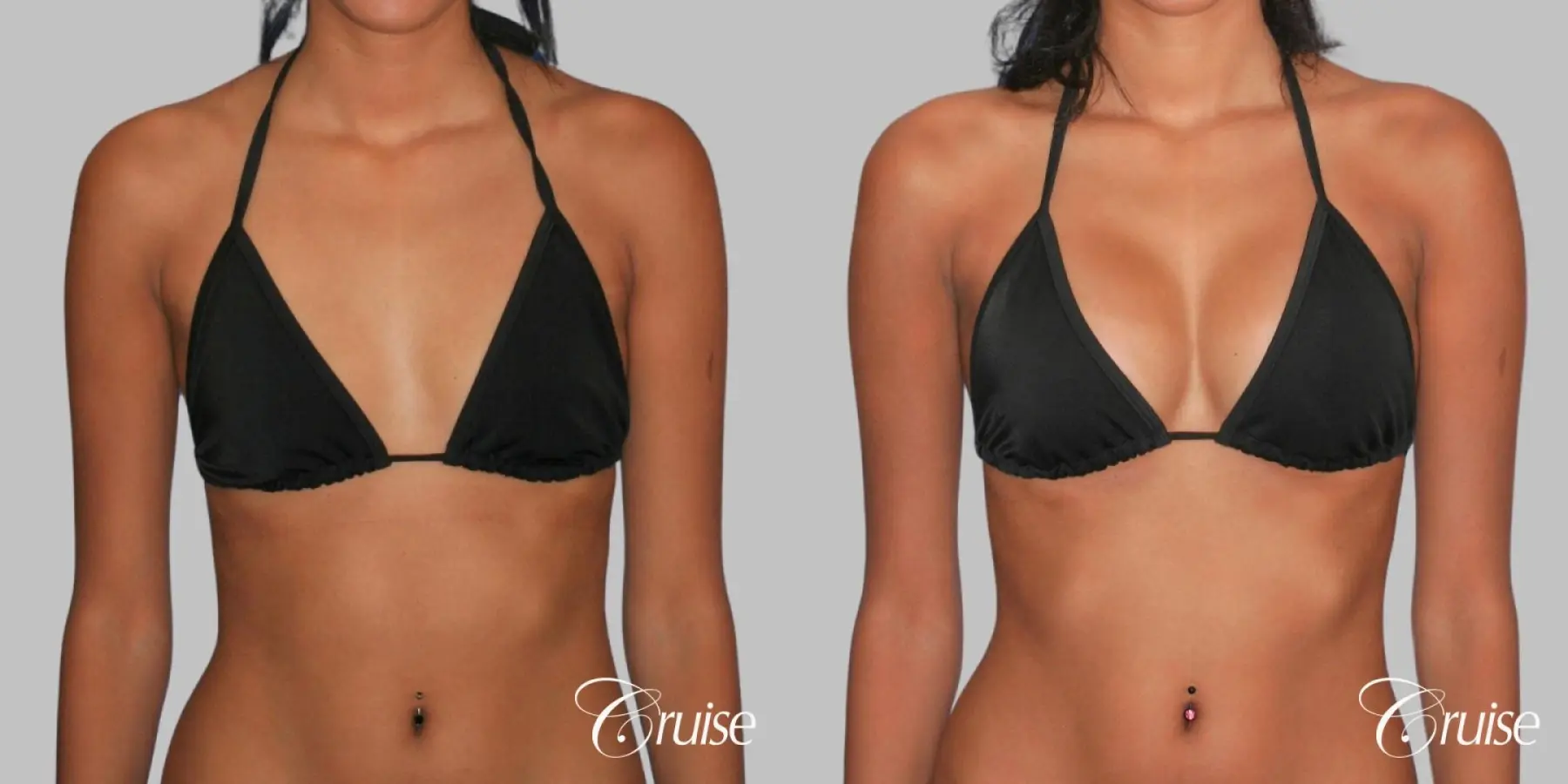 Breast Augmentation - Silicone MP 371cc - Before and After 4