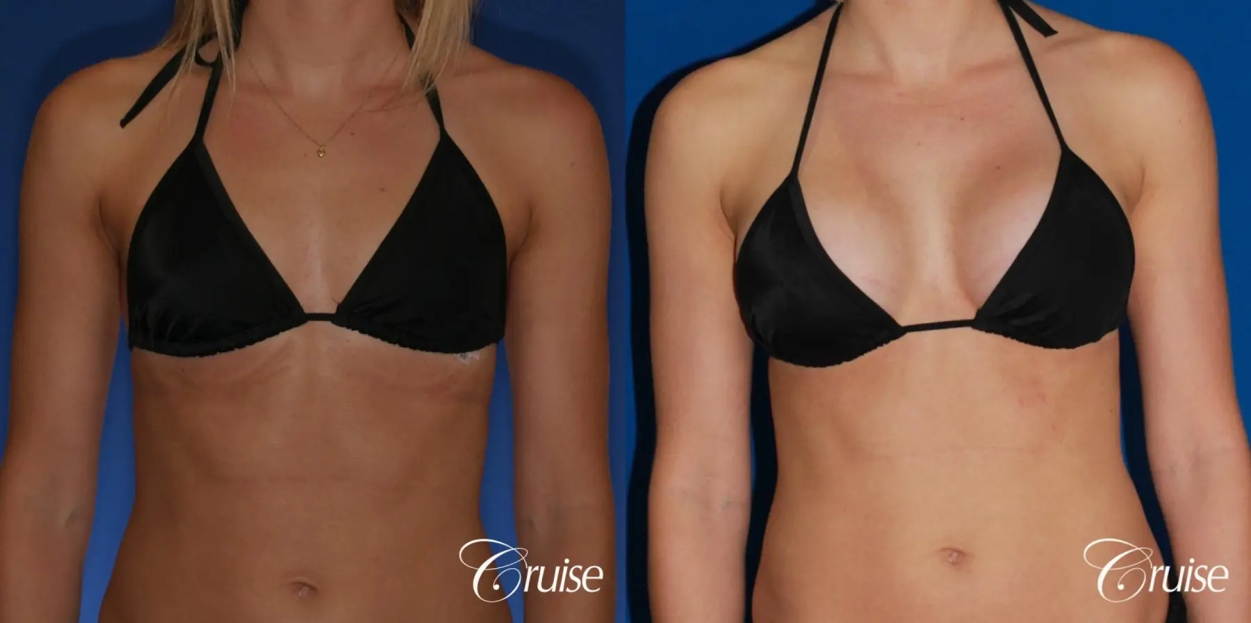 Breast Augmentation - Before and After 4