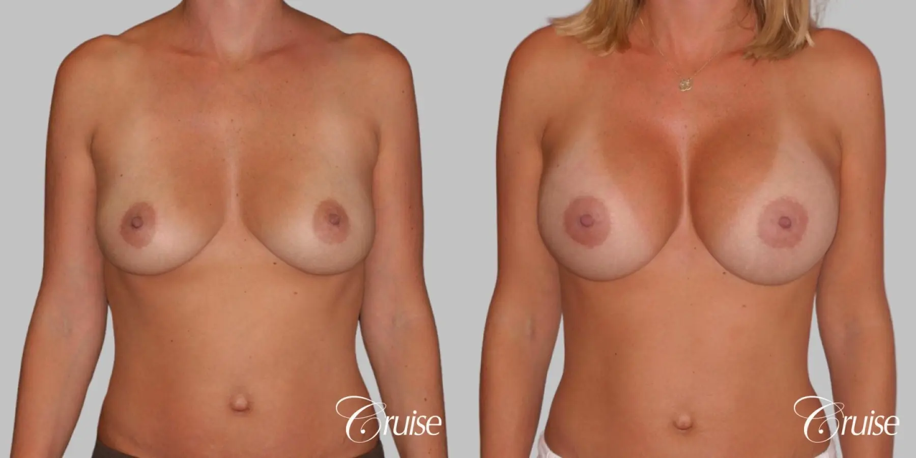 Breast Augmentation - Silicone MP 339cc - Before and After 1