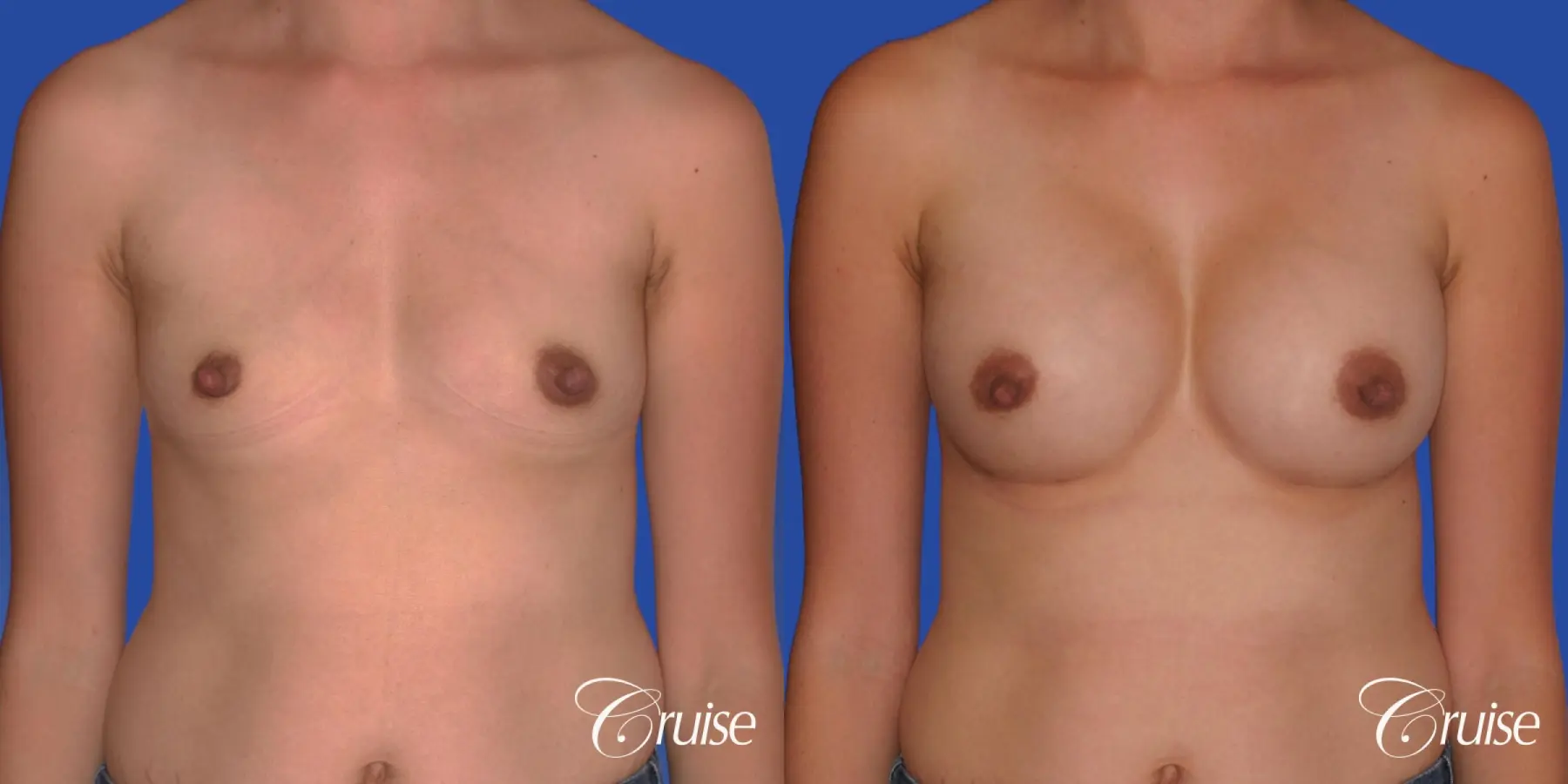 Breast Augmentation: Patient 43 - Before and After 1