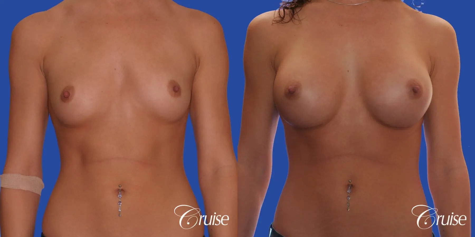 Breast Augmentation - Before and After  