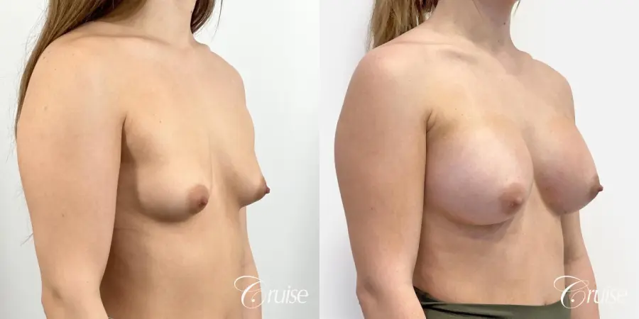 Silicone Gel Breast Implants - Before and After 2