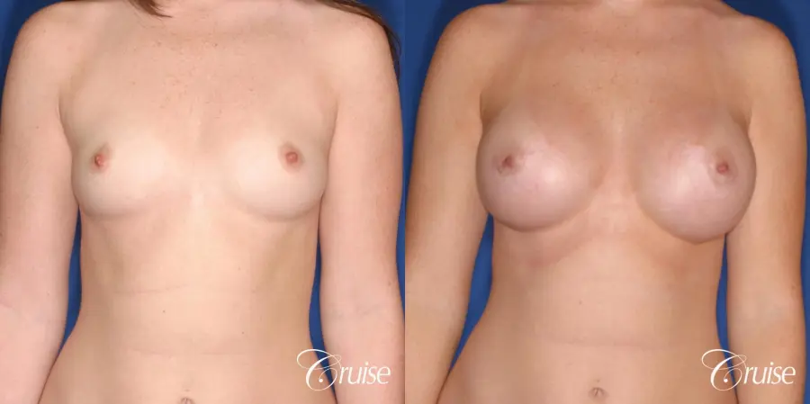 Breast Augmentation: Patient 45 - Before and After 1