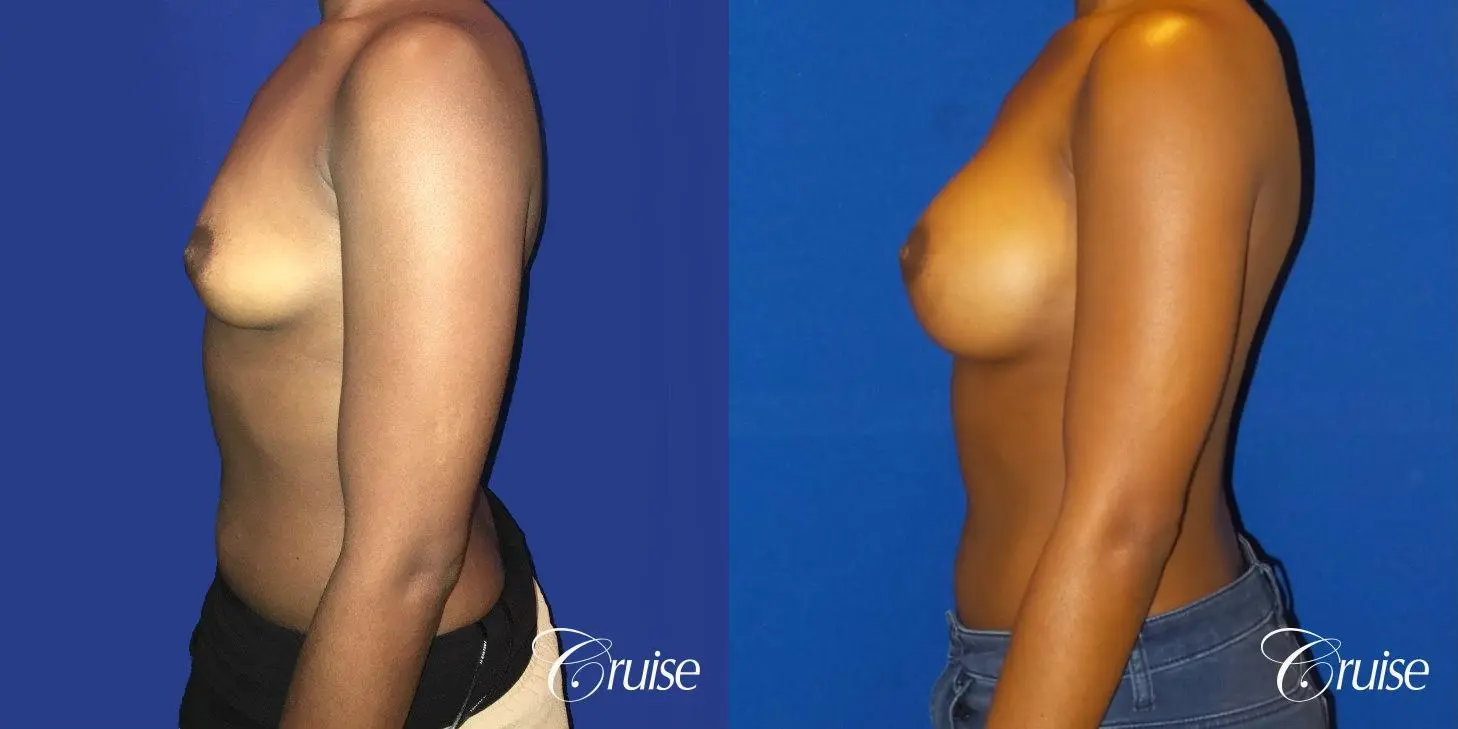 Breast Augmentation surgery Dr. Cruise - Before and After 3