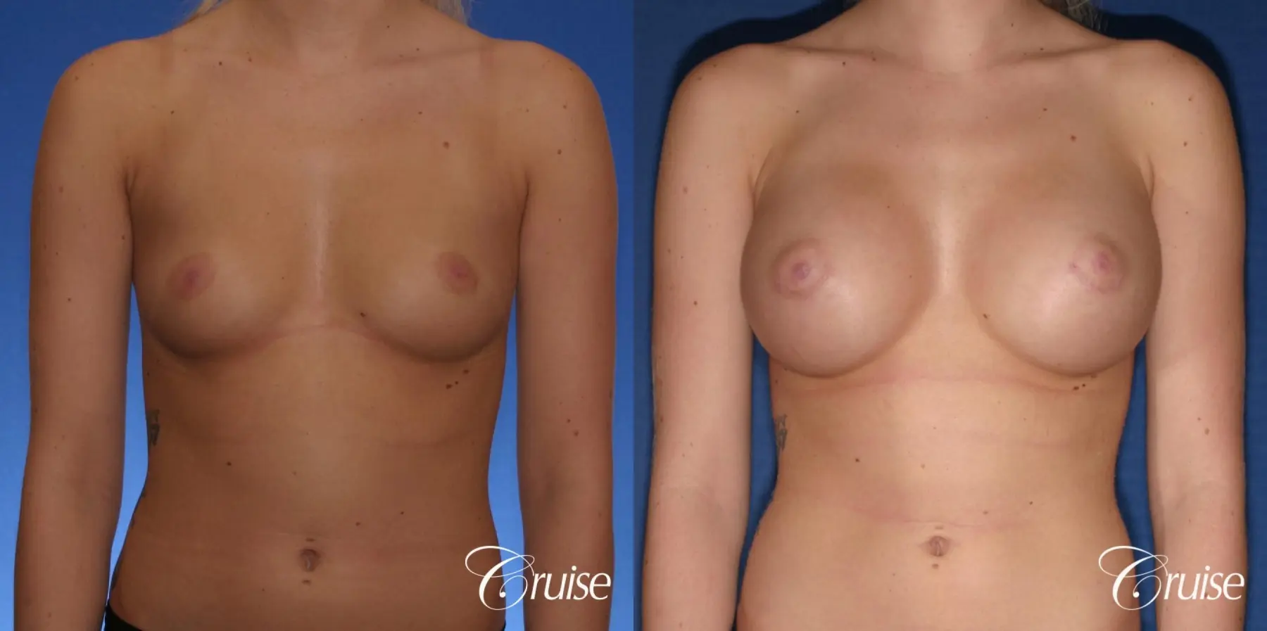 Breast Augmentation - Before and After 1