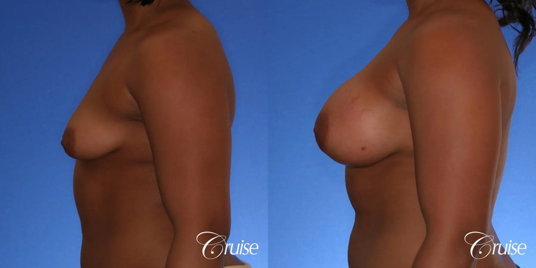 Breast Augmentation - Before and After 2