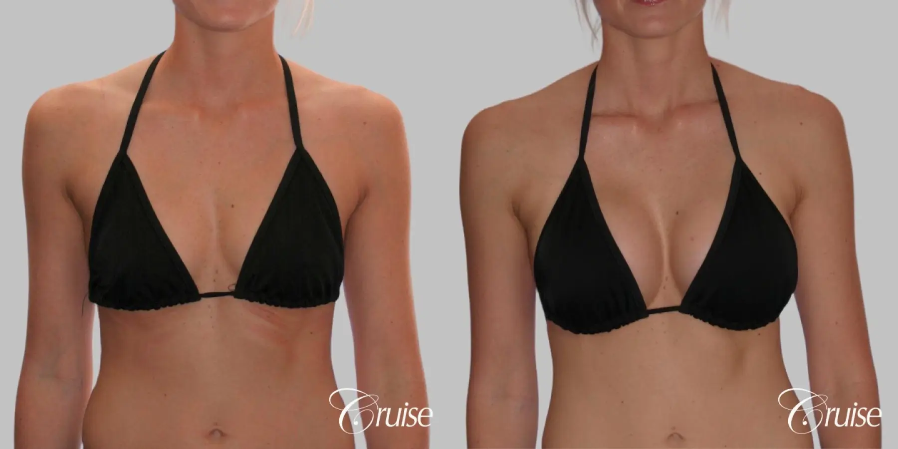 Breast Augmentation - Silicone HP 425cc - Before and After 4