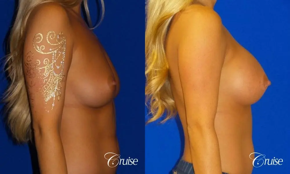 Breast Augmentation Irvine CA - Before and After 2