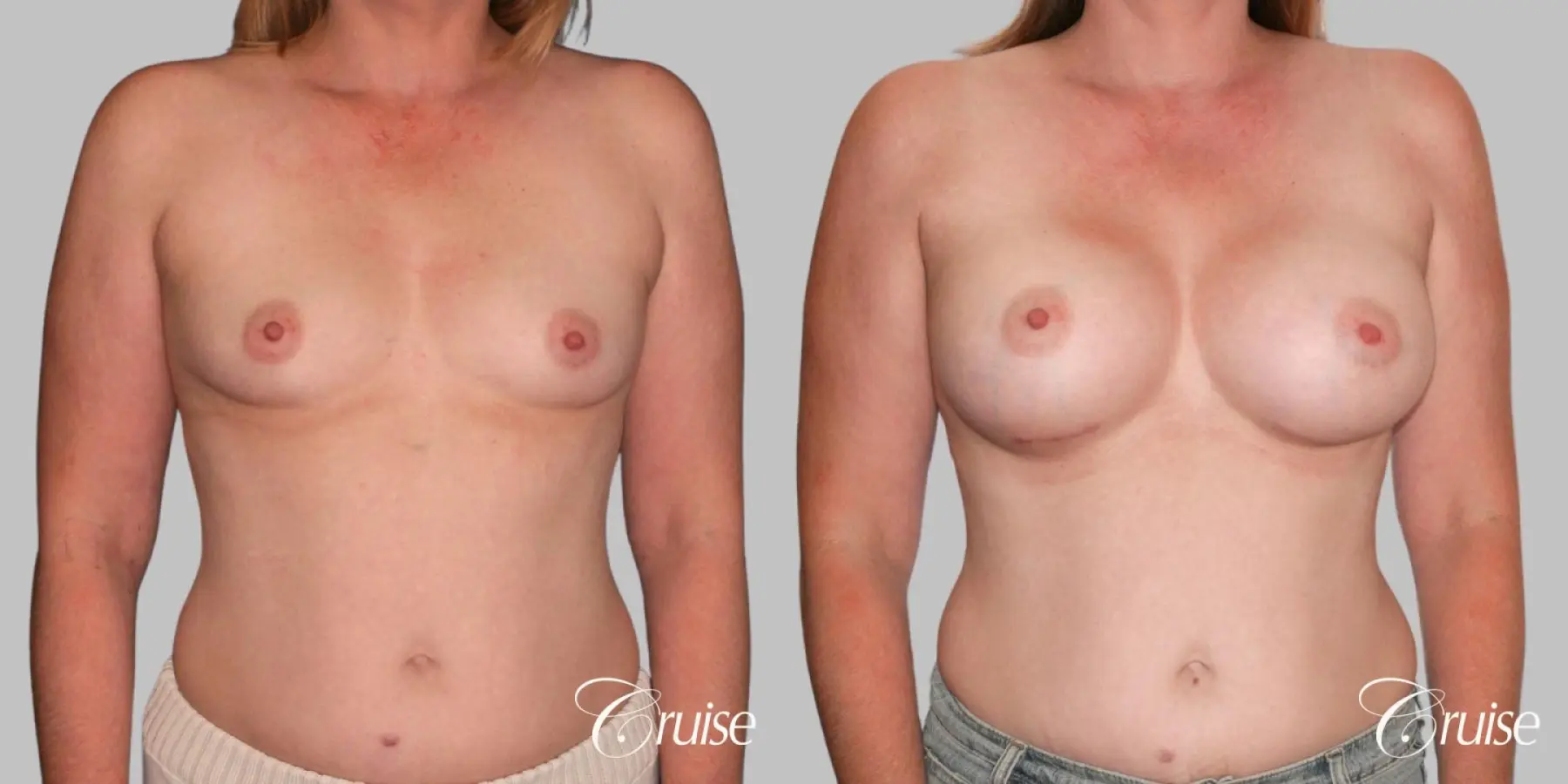 Breast Augmentation - Silicone HP 475cc - Before and After 1