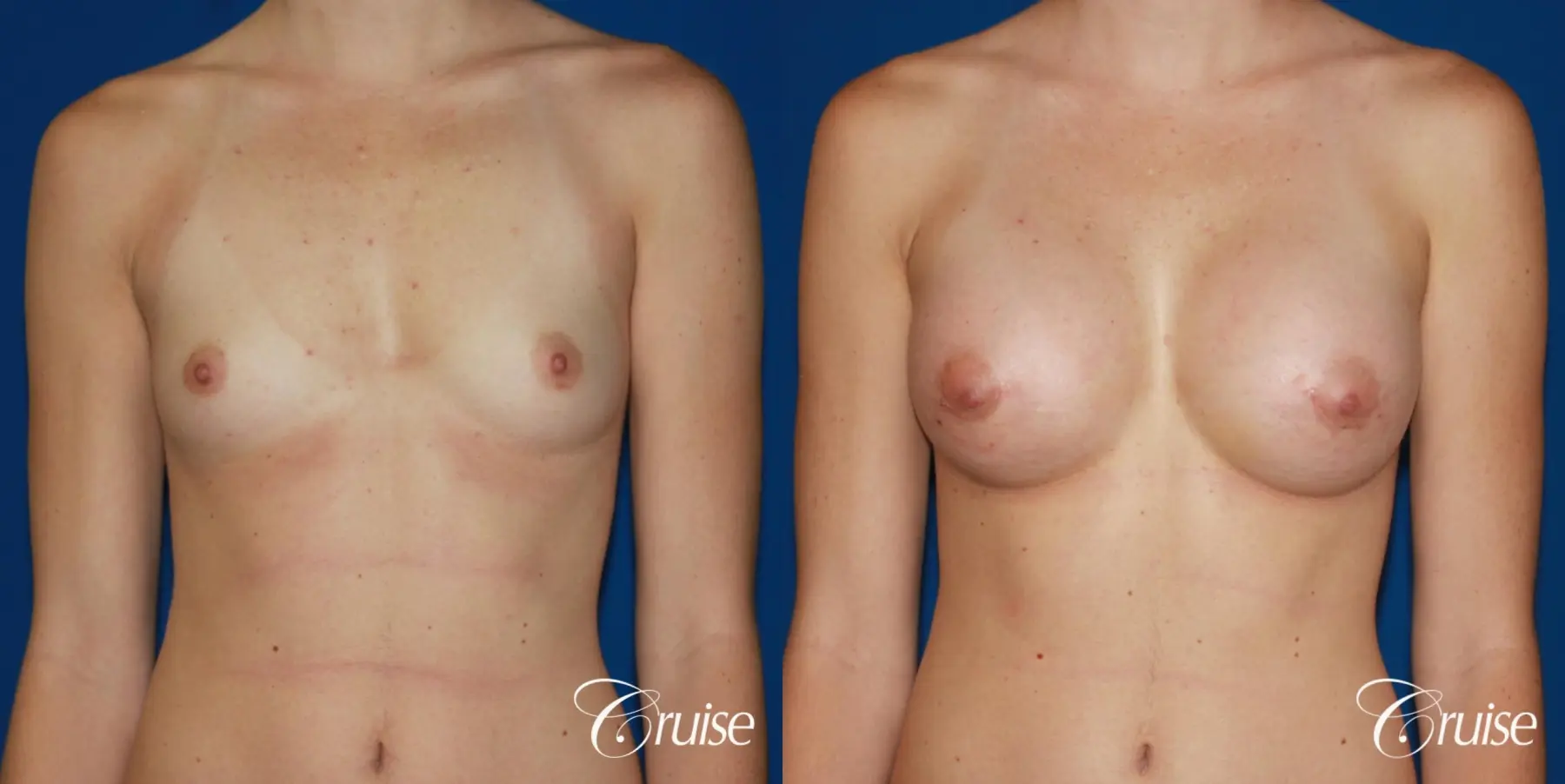 Breast Augmentation - Before and After 1