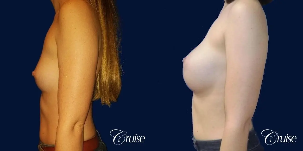 Breast Augmentation - Before and After 3