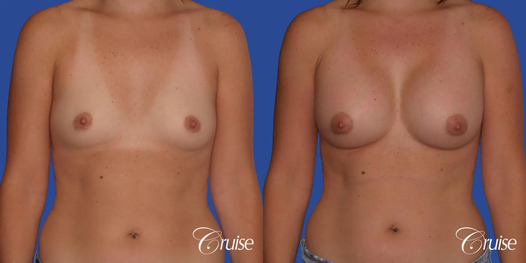 Breast Augmentation - Before and After 1