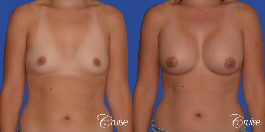 Breast Augmentation - Before and After 1