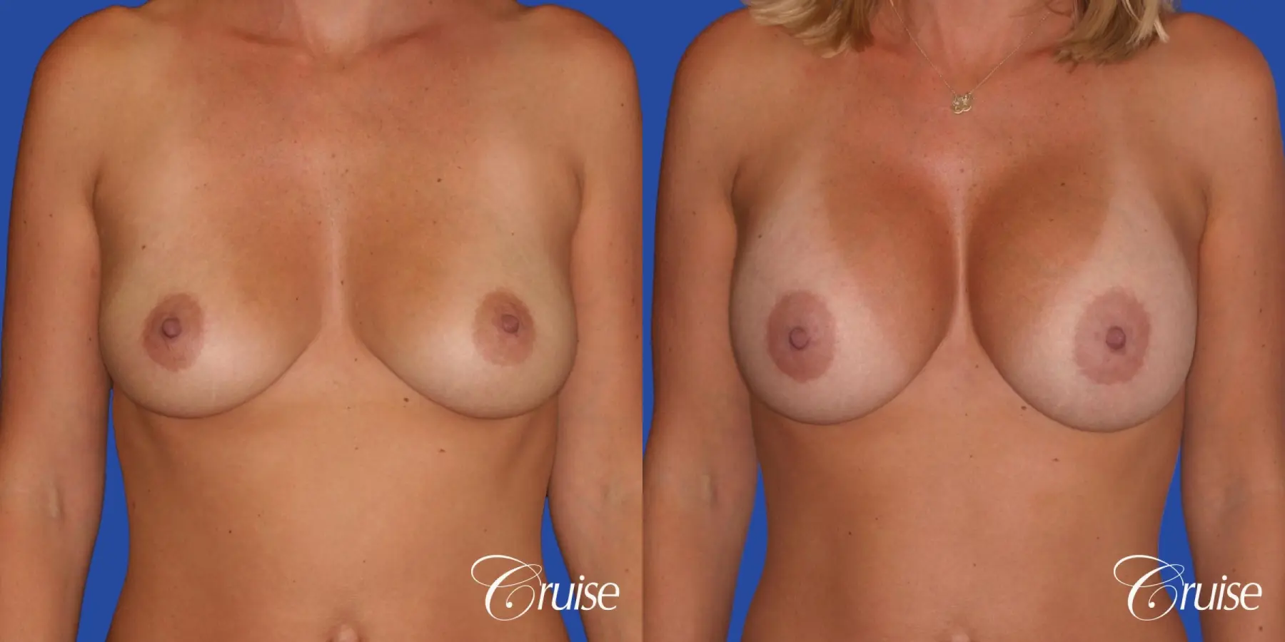 Breast Augmentation - Before and After 1